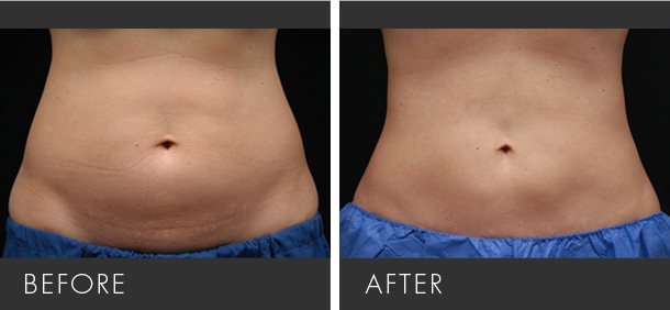 Before and After Coolsculpting