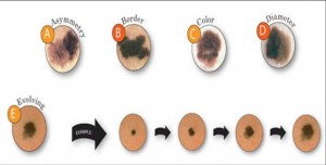 Melanoma stages graphic