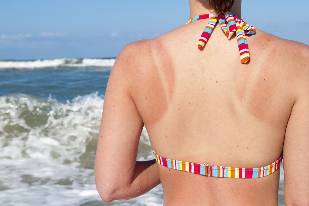 Woman wearing a swimsuit with tan lines and sunburn on her back