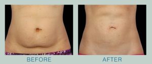 SR-B-A-coolsculpting4