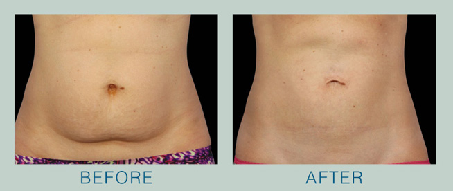 Before and After Coolsculpting