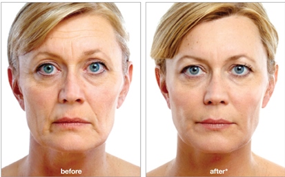 Before and after juvederm voluma aesthetic solution