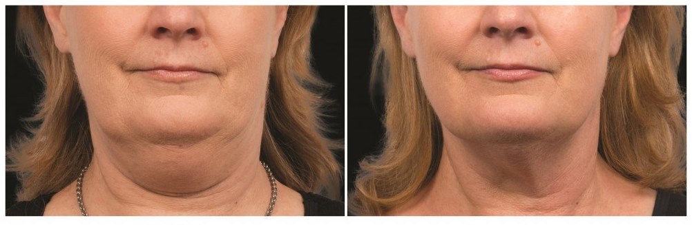 Before and after coolsculpting