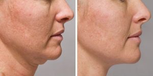 kybella-treatments-mi-before-after-03