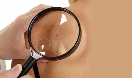 Examining mole with magnifying glass