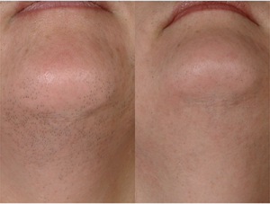 denver-laser-hair-removal-chin