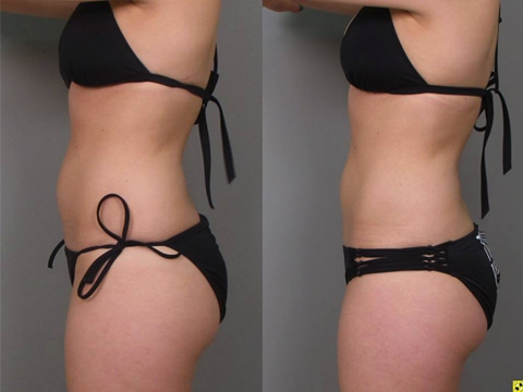 Before and after Swimsuit image