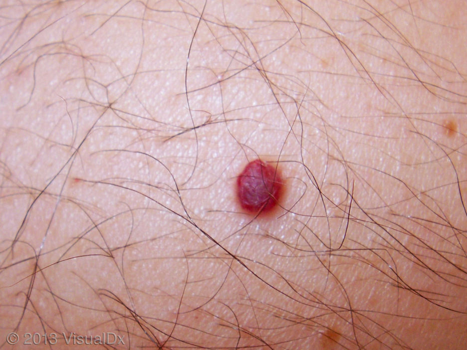 Cherry Hemangioma