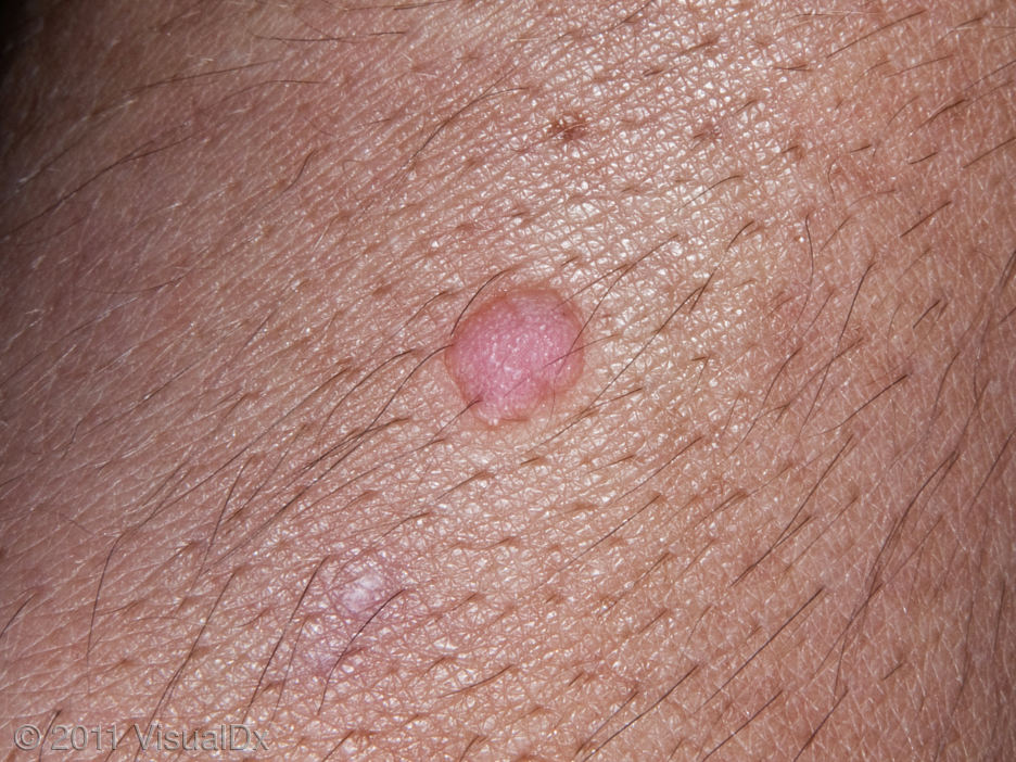 Zoomed in image of a wart