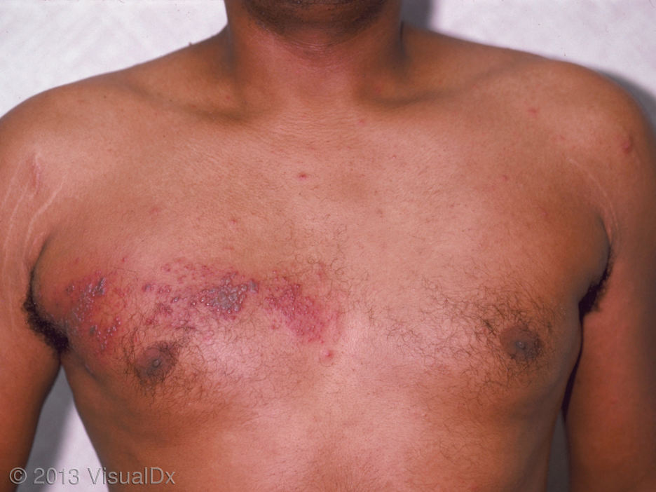 Shingles on men's chest