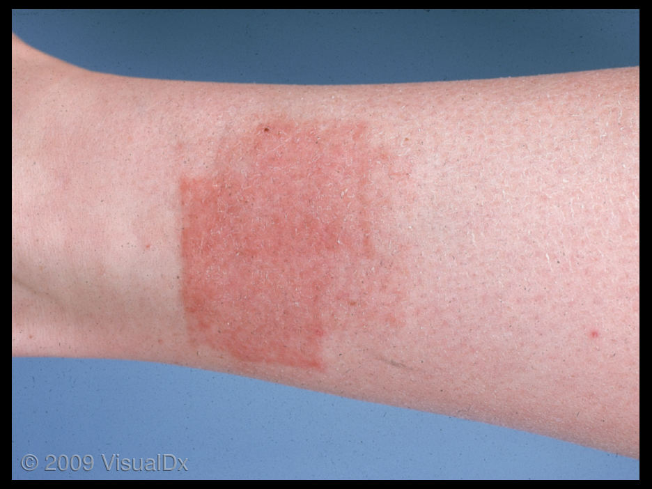 Contact dermatitis on wrist