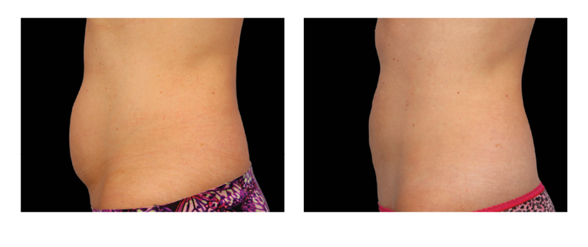 Before and After Coolsculpting