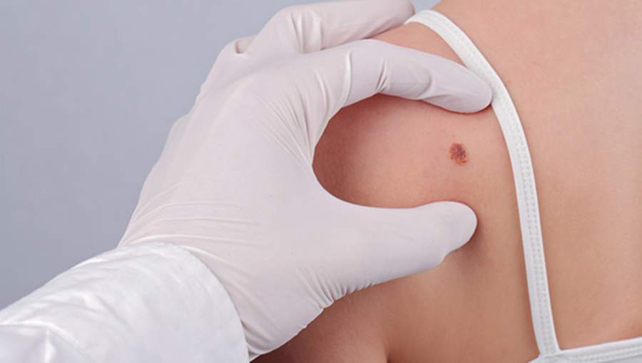 Examining mole wearing white latex glove