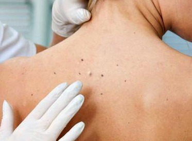 Skin Cancer Screening