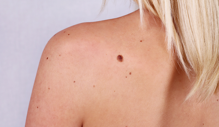 Mole on a woman's back