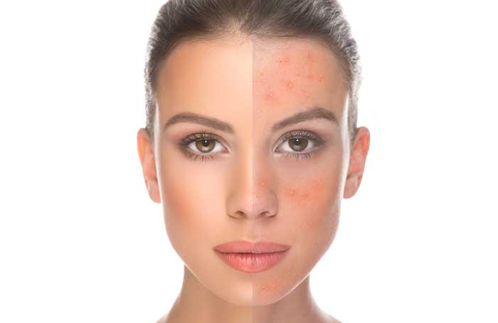 Home remedies for Rosacea