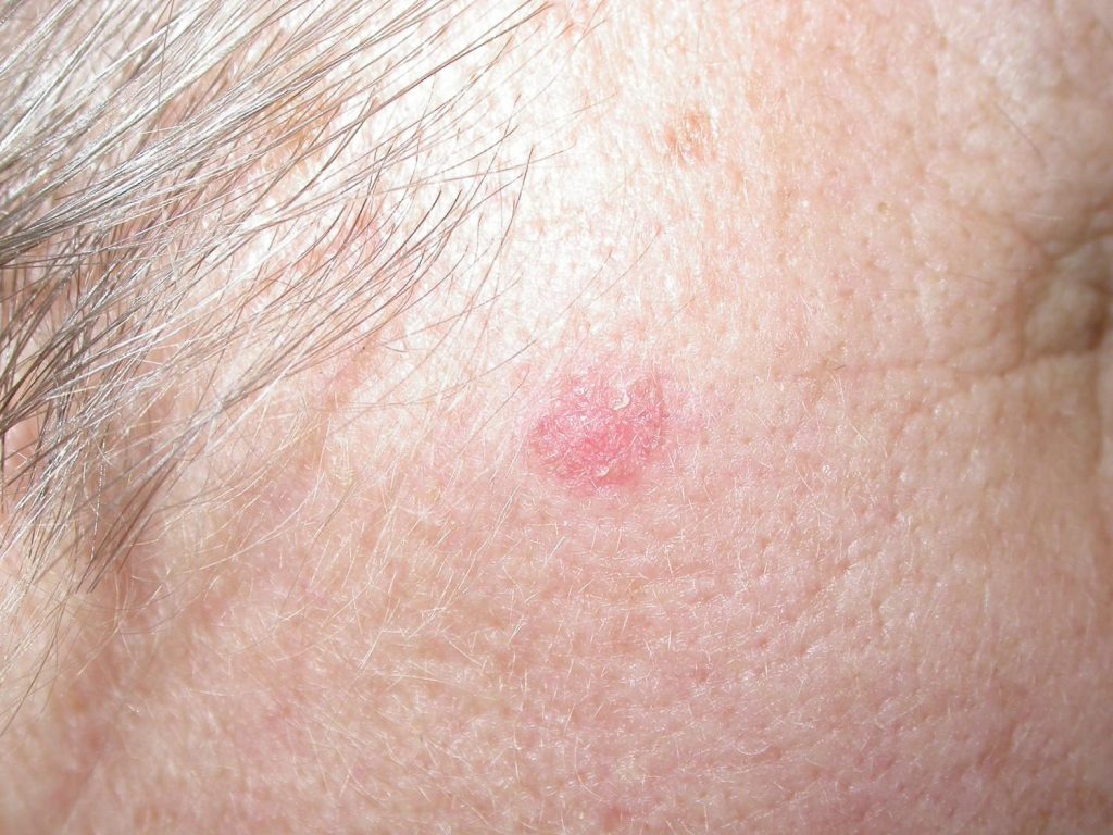 Topical skin blemish