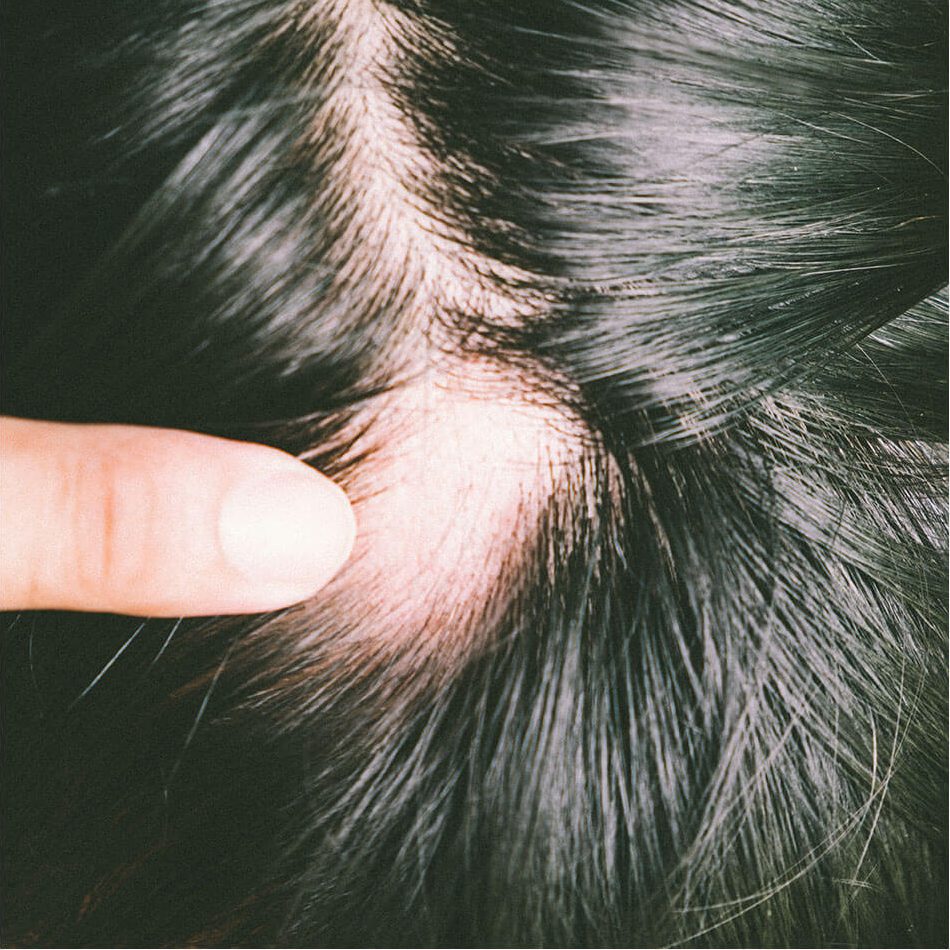 Zoomed in image showing alopecia balding