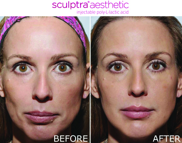 Before and after of sculptra aesthetic