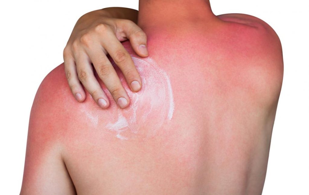 Sunburn on a man's back