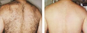 laser hair removal before and after of male back