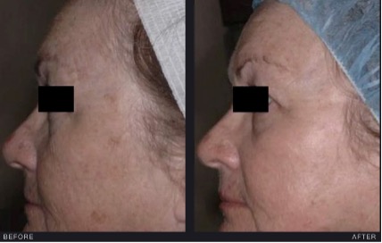 Before and After CO2 laser treatment