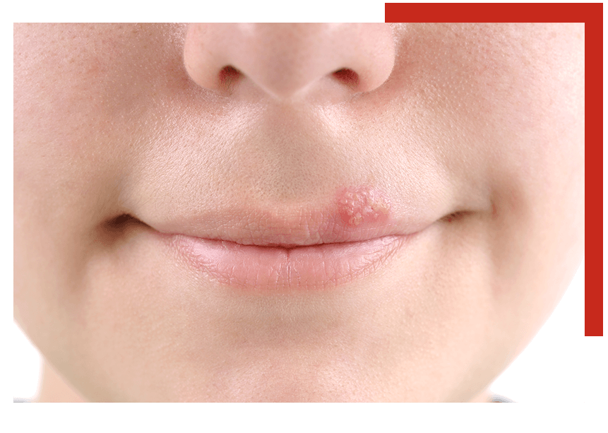 Herpes above upper lip