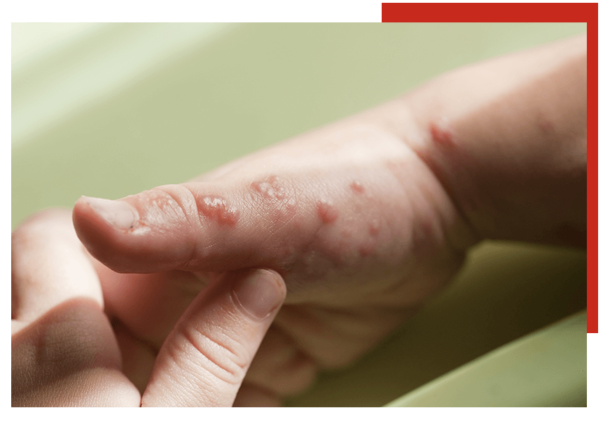 Shingles on hand