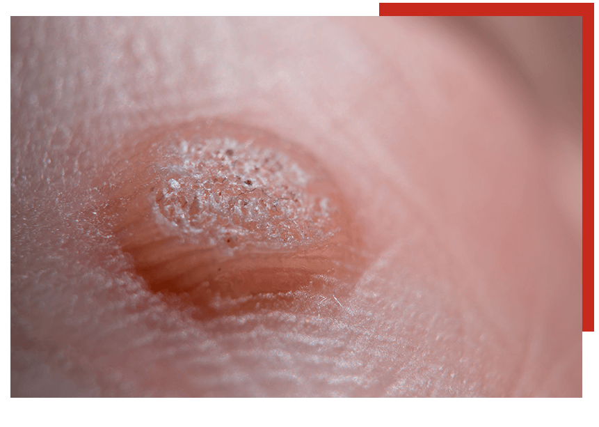 Zoomed in image of a wart