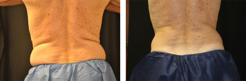 Before and after CoolSculpting® on male sides