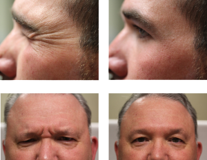 Before and after BOTOX®/ Dysport® on male faces