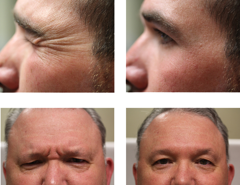 Before and after BOTOX®/ Dysport® on male faces