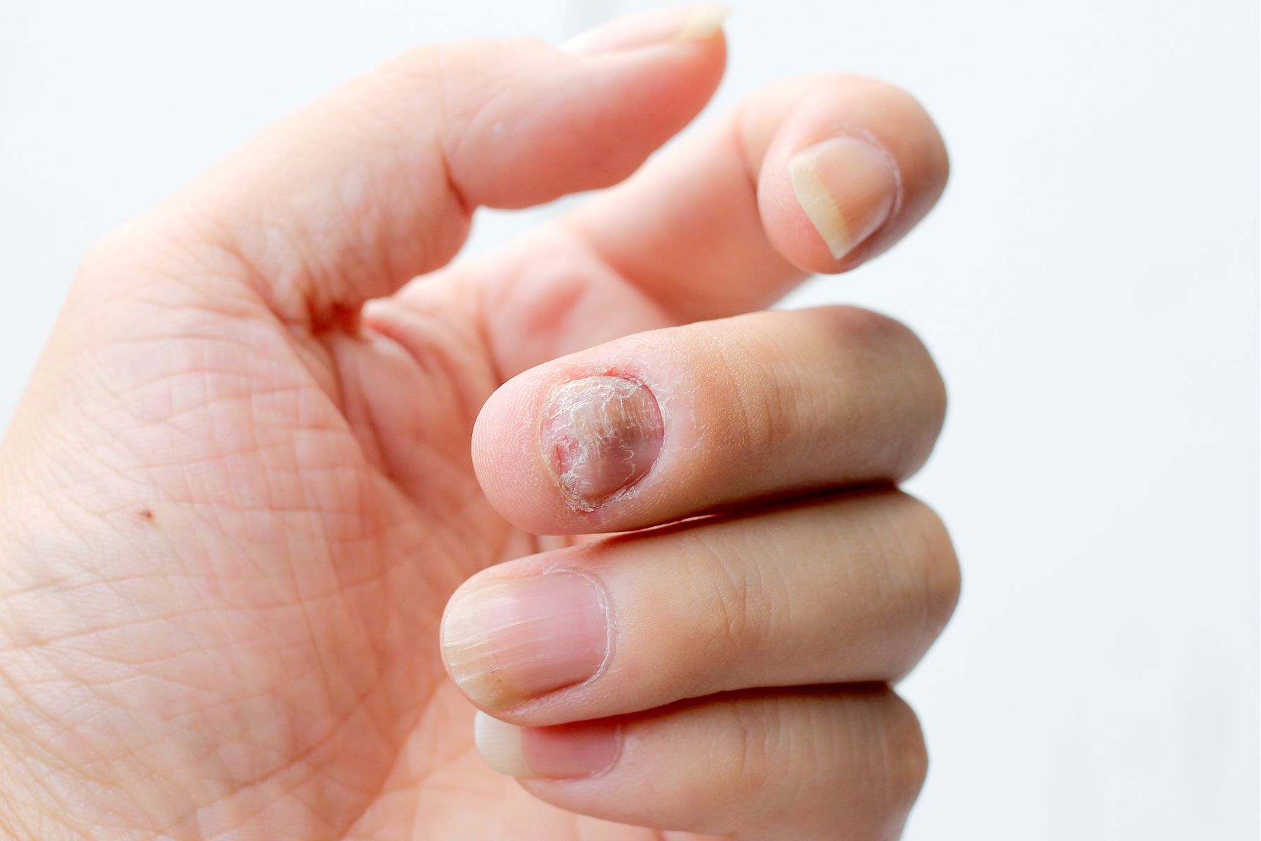 Model showing psoriasis on nail