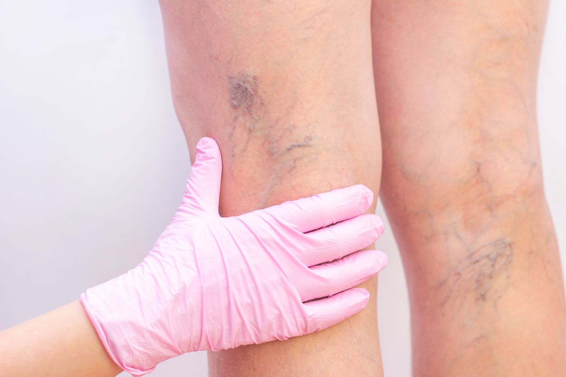 Sclerotherapy