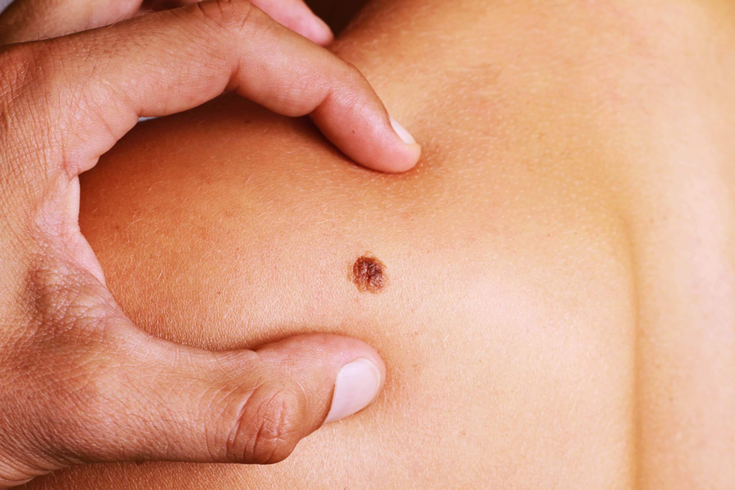 The basics of mohs skin cancer surgery