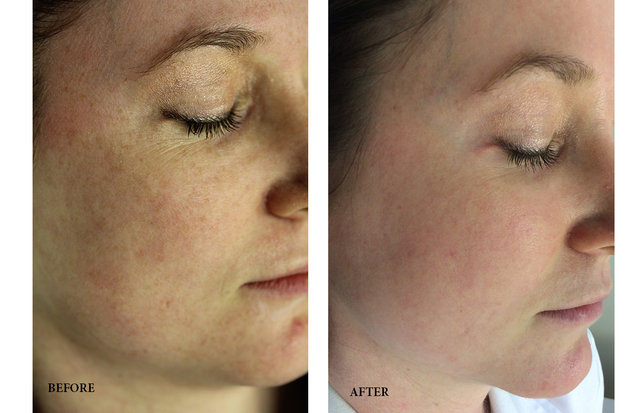 Get rid of brown spots with FRAXEL laser