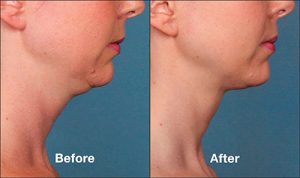 female-kybella-patient