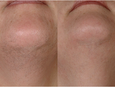 Start NOW for Smooth Skin this Summer - Sutton Dermatology + Aesthetics Ctr