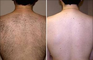 laser-hair-removal-before-after-back
