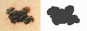 An example of a irregular mole