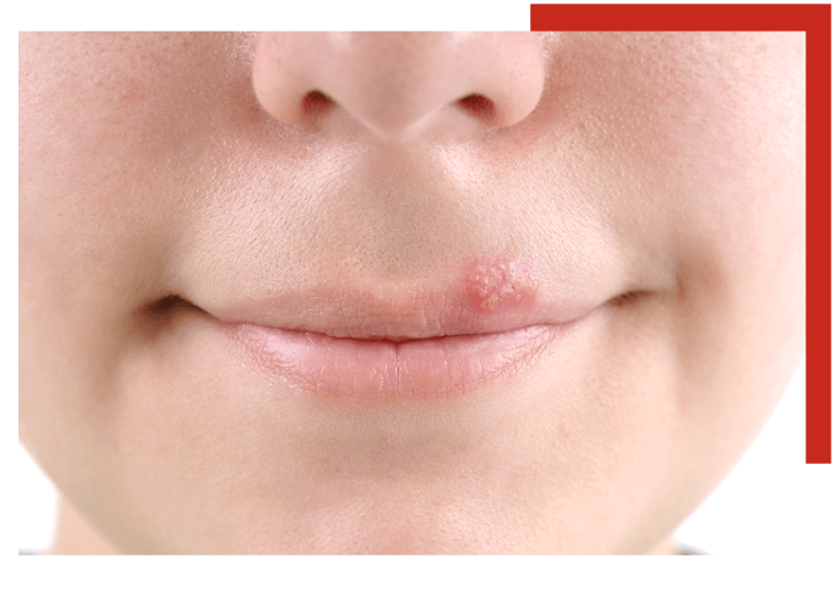 what is the presentation of herpes simplex